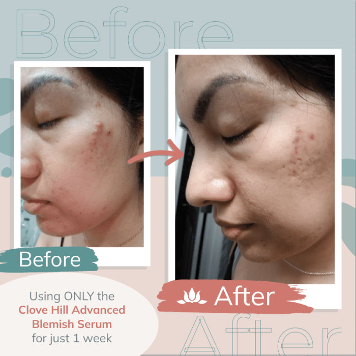 Clove Hill Advanced Blemish Serum